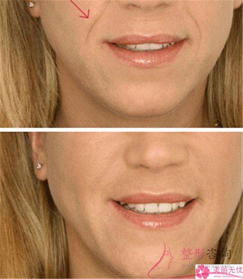 脂肪和透明質酸是不是均可以被作為去除法令紋的醫用材料