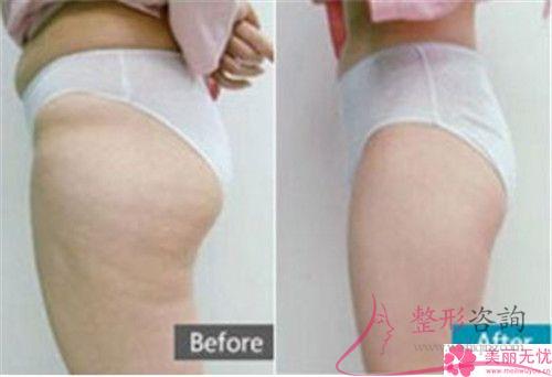 自體組織<a href=http://www.f3bb6.cn/listinfo-677-0.html target=_blank class=infotextkey>豐臀</a>的四個優點