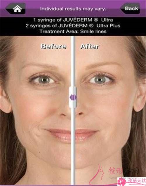 鋸齒線懸掛緊致去皺術到底有哪些具體的功能