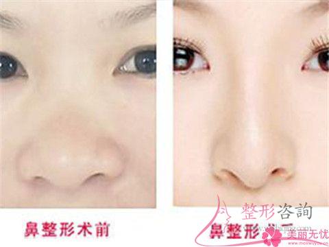 <a href=http://www.f3bb6.cn/listinfo-754-0.html target=_blank class=infotextkey>鼻翼</a>縮小術(shù)大概會發(fā)生哪些風(fēng)險