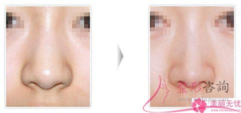 <a href=http://www.f3bb6.cn/listinfo-754-0.html target=_blank class=infotextkey>鼻翼</a>縮小術(shù)大概會發(fā)生哪些風(fēng)險