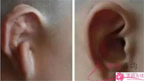 傷口沾水后不利于自體脂肪<a href=http://www.f3bb6.cn/listinfo-694-0.html target=_blank class=infotextkey>豐耳垂</a>后的恢復(fù)嗎