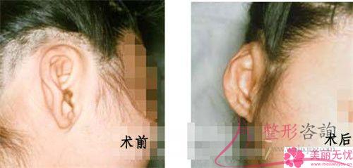 傷口沾水后不利于自體脂肪<a href=http://www.f3bb6.cn/listinfo-694-0.html target=_blank class=infotextkey>豐耳垂</a>后的恢復(fù)嗎