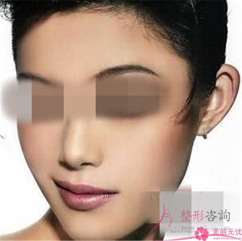 傷口沾水后不利于自體脂肪<a href=http://www.f3bb6.cn/listinfo-694-0.html target=_blank class=infotextkey>豐耳垂</a>后的恢復(fù)嗎