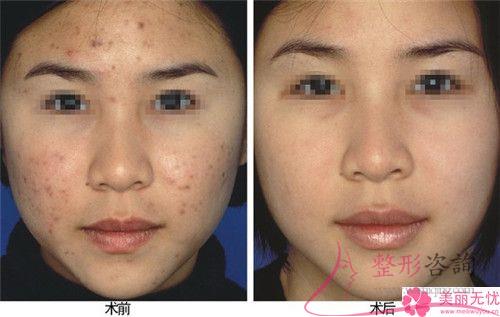 激光去痘痕大概的費(fèi)用是多少