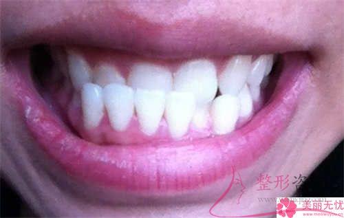 最科學的<a href=http://www.f3bb6.cn/listinfo-824-0.html target=_blank class=infotextkey>牙齒矯正</a>類型具體有哪些