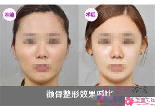 顴骨內縮手術與其它磨顴骨手術相比有什么優點