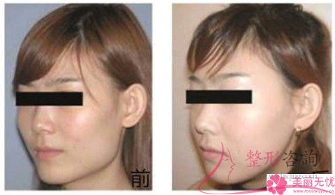 顴骨內縮手術與其它磨顴骨手術相比有什么優點