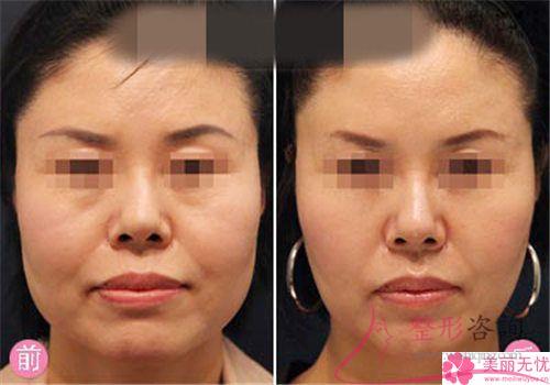 除了手術方法還可以有哪些方法來解決下巴歪的問題