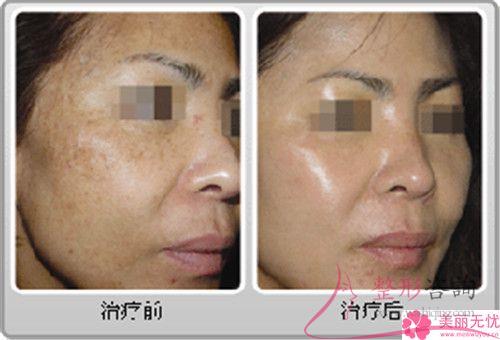 <a href=http://www.f3bb6.cn/listinfo-795-0.html target=_blank class=infotextkey>祛斑</a>大約費(fèi)用