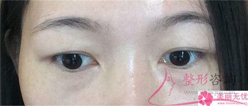 超聲法<a href=http://www.f3bb6.cn/listinfo-708-0.html target=_blank class=infotextkey>去眼袋</a>多久可以恢復(fù)好