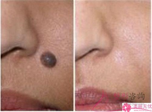 彩光去除黃褐斑和<a href=http://www.f3bb6.cn/listinfo-790-0.html target=_blank class=infotextkey>水光針</a>一同實施多少錢