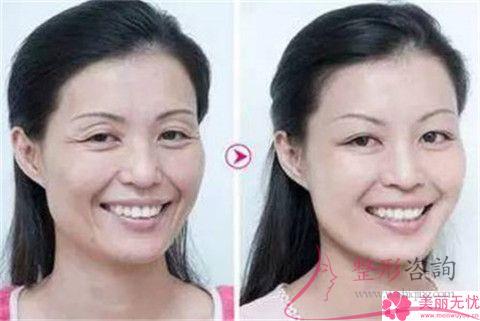 彩光<a href=http://www.f3bb6.cn/listinfo-770-0.html target=_blank class=infotextkey>嫩膚</a>祛痘要幾個療效？祛痘價位貴嗎？