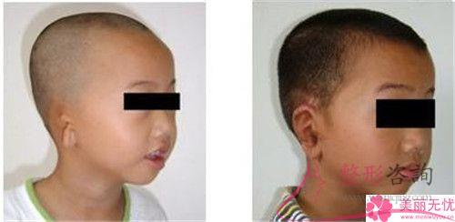 拴馬樁耳整形術流程究竟是怎么樣的