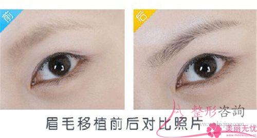 根狀眉的效應有哪些