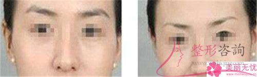 <a href=http://www.f3bb6.cn/listinfo-658-0.html target=_blank class=infotextkey>洗眉</a>毛用激光能清潔凈嗎？費用是呢