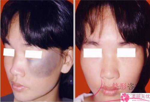 激光<a href=http://www.f3bb6.cn/listinfo-795-0.html target=_blank class=infotextkey>祛斑</a>反黑現象怎么做