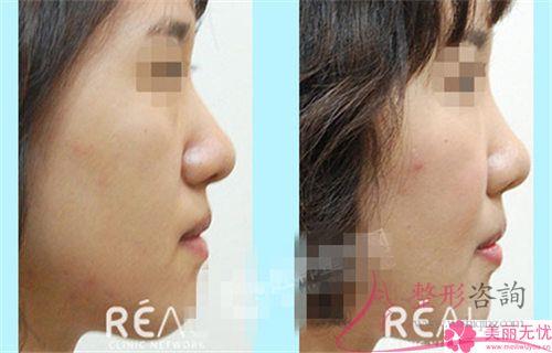 短鼻延長術合適哪種人做