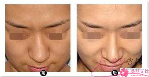 蒜頭鼻醫(yī)療美容結(jié)束以后跟沒有進行之前差別會不會比較顯目