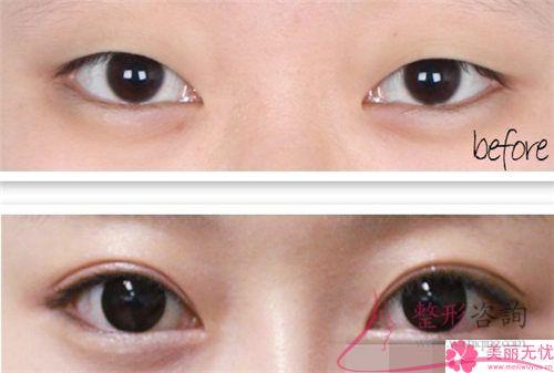 韓式<a href=http://www.f3bb6.cn/listinfo-724-0.html target=_blank class=infotextkey>雙眼皮</a>法是埋線<a href=http://www.f3bb6.cn/listinfo-724-0.html target=_blank class=infotextkey>雙眼皮</a>法嗎？是可以保持多長時(shí)間