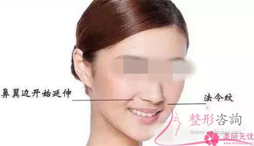 四個高頻出現的除掉法令紋的不良癥狀