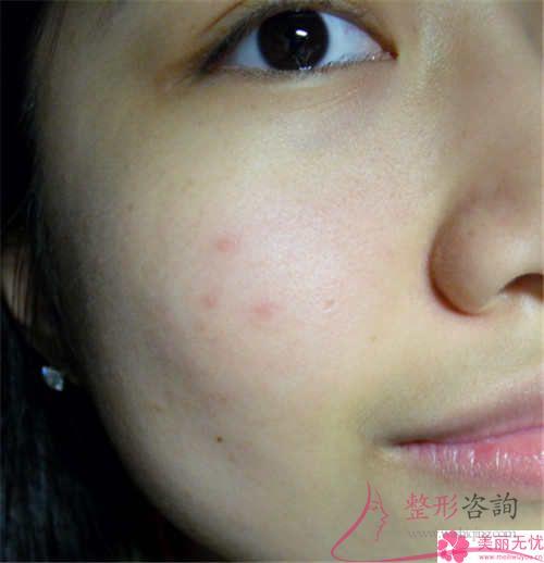 外眼角切開術的含義?有留疤痕的危害嗎?