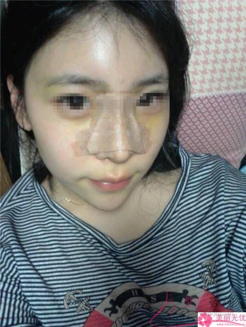 打微晶瓷<a href=http://www.f3bb6.cn/listinfo-737-0.html target=_blank class=infotextkey>隆鼻</a>的注意事項有哪些