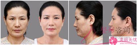 <a href=http://www.f3bb6.cn/listinfo-610-0.html target=_blank class=infotextkey>熱瑪吉</a>緊膚術的效果都有幾個