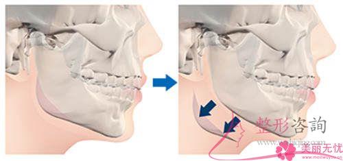 <a href=http://www.f3bb6.cn/listinfo-629-0.html target=_blank class=infotextkey>下頜角</a>磨骨有并發(fā)癥嗎?有哪些副作用?