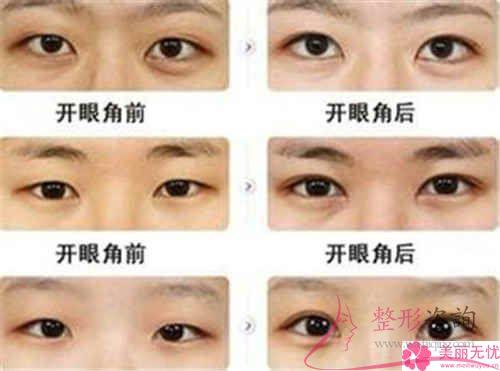 不同的6大<a href=http://www.f3bb6.cn/listinfo-711-0.html target=_blank class=infotextkey>開眼角</a>手術的優點