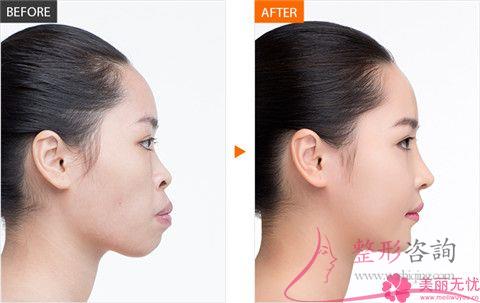 不美觀的<a href=http://www.f3bb6.cn/listinfo-754-0.html target=_blank class=infotextkey>鼻翼</a>應當怎么做
