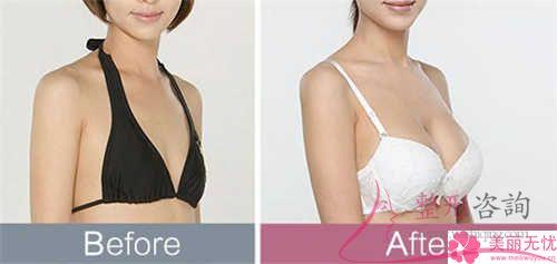 妙桃假體<a href=http://www.f3bb6.cn/listinfo-618-0.html target=_blank class=infotextkey>隆胸</a>以后啥子原因會(huì)引發(fā)乳房表層麻木感？