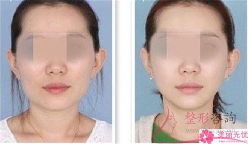 手術方法進行面部縮緊對皮膚破壞大不大