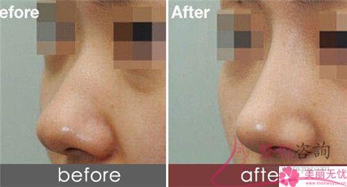 短鼻延長術美化效果如何