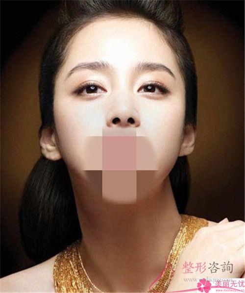 肉毒桿菌針劑得以去掉額頭紋嗎