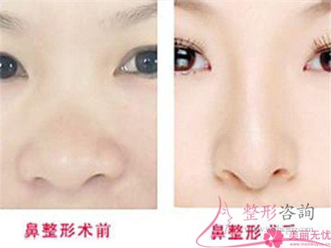 過大的<a href=http://www.f3bb6.cn/listinfo-754-0.html target=_blank class=infotextkey>鼻翼</a>是需如何矯正