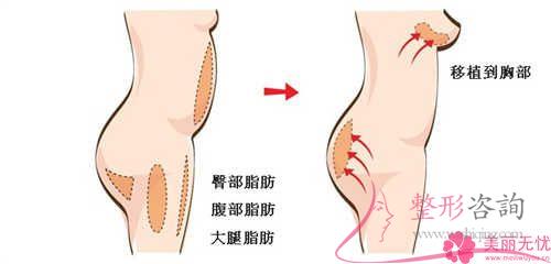 雅靚假體<a href=http://www.f3bb6.cn/listinfo-618-0.html target=_blank class=infotextkey>隆胸</a>手術過后哪些事項可幫助各位增加康復?多長時間可以愈合?