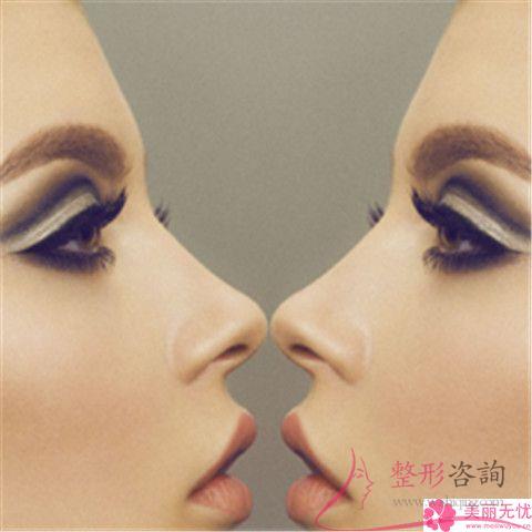 做縮小<a href=http://www.f3bb6.cn/listinfo-754-0.html target=_blank class=infotextkey>鼻翼</a>的價格如何收費