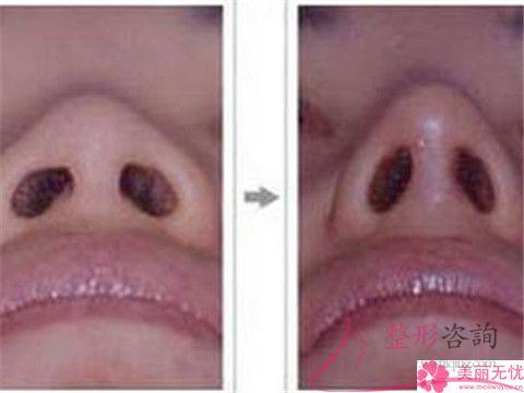 做鼻頭<a href=http://www.f3bb6.cn/listinfo-754-0.html target=_blank class=infotextkey>鼻翼</a>縮小價(jià)格怎么定位