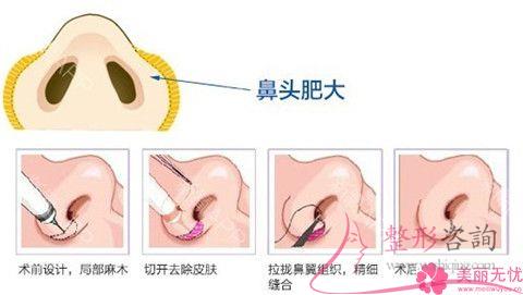做<a href=http://www.f3bb6.cn/listinfo-754-0.html target=_blank class=infotextkey>鼻翼</a>整形術價格介紹