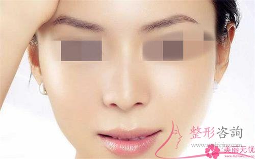 <a href=http://www.f3bb6.cn/listinfo-737-0.html target=_blank class=infotextkey>隆鼻</a>手術(shù)后完全恢復(fù)需要花多久的時(shí)間