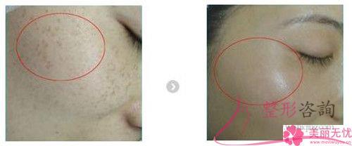 醫美<a href=http://www.f3bb6.cn/listinfo-795-0.html target=_blank class=infotextkey>祛斑</a>期間如果臉上特別紅正常嗎