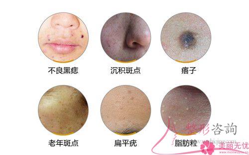 醫美<a href=http://www.f3bb6.cn/listinfo-795-0.html target=_blank class=infotextkey>祛斑</a>期間如果臉上特別紅正常嗎