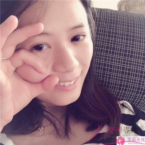 填充蘋果肌后出現(xiàn)移位的概率大不大