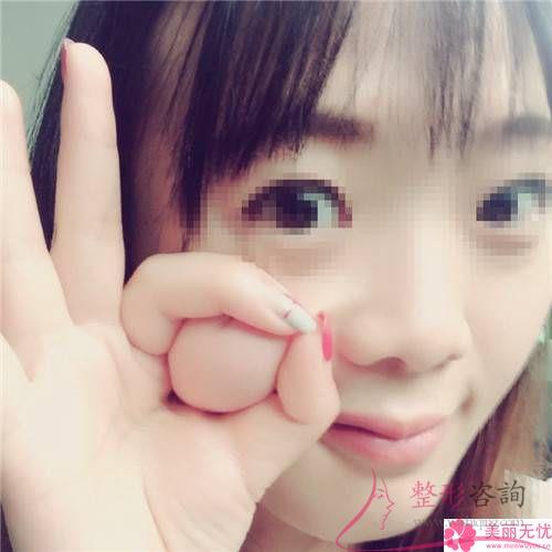 填充蘋果肌后出現(xiàn)移位的概率大不大