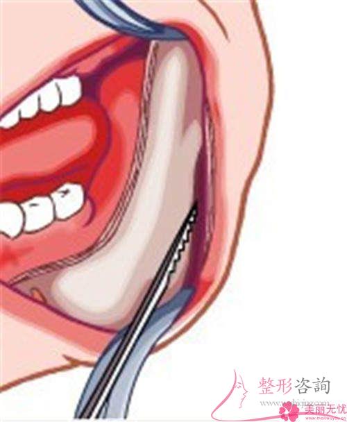 下頜骨磨骨并發癥高嗎