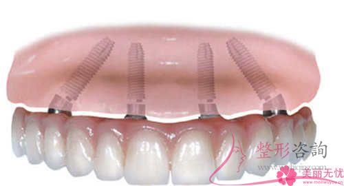 什么是種植牙與所需花銷