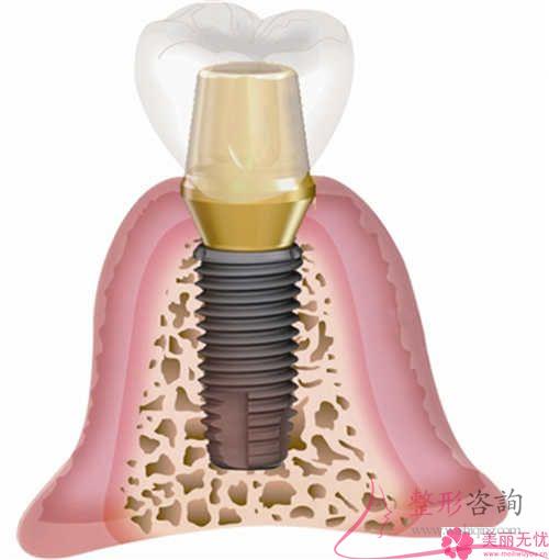 什么是種植牙與所需花銷