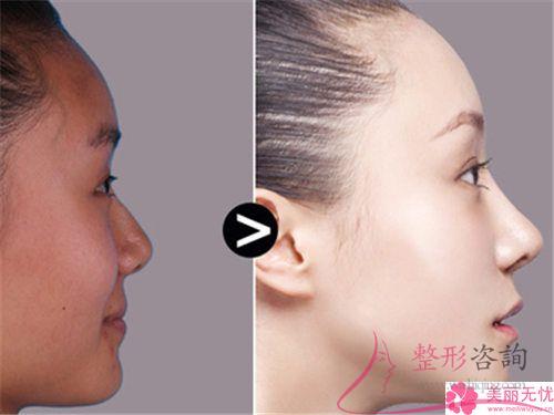 假體<a href=http://www.f3bb6.cn/listinfo-737-0.html target=_blank class=infotextkey>隆鼻</a>術(shù)效果若何體現(xiàn)