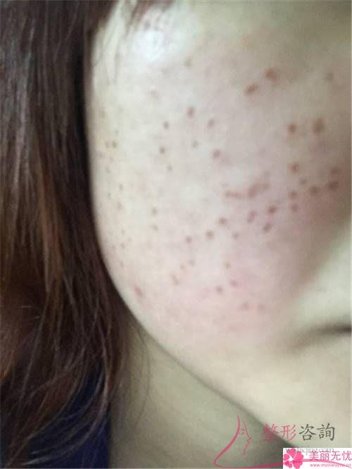 光動力祛痘需花幾個療效？去痘價格會很貴嗎？